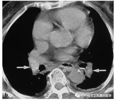 ct平扫肺部能查出是哮喘吗,ct平扫肺结节准确吗