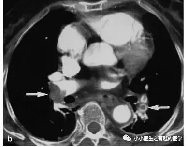 ct平扫肺部能查出是哮喘吗,ct平扫肺结节准确吗