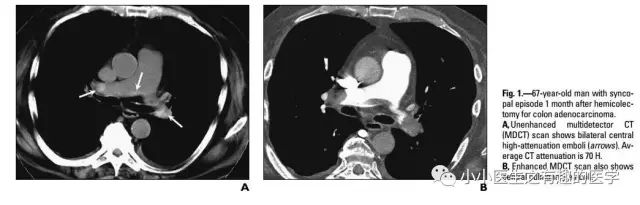 ct平扫肺部能查出是哮喘吗,ct平扫肺结节准确吗