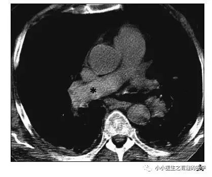 ct平扫肺部能查出是哮喘吗,ct平扫肺结节准确吗