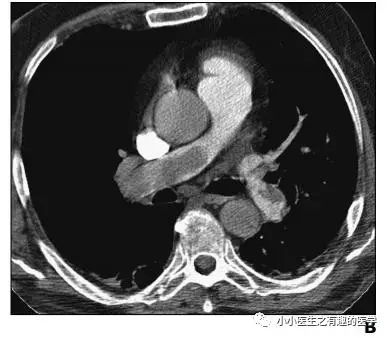 ct平扫肺部能查出是哮喘吗,ct平扫肺结节准确吗