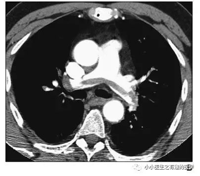 ct平扫肺部能查出是哮喘吗,ct平扫肺结节准确吗