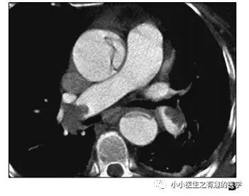 ct平扫肺部能查出是哮喘吗,ct平扫肺结节准确吗