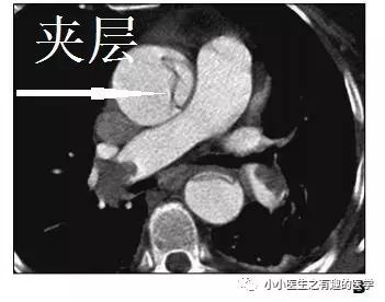 ct平扫肺部能查出是哮喘吗,ct平扫肺结节准确吗