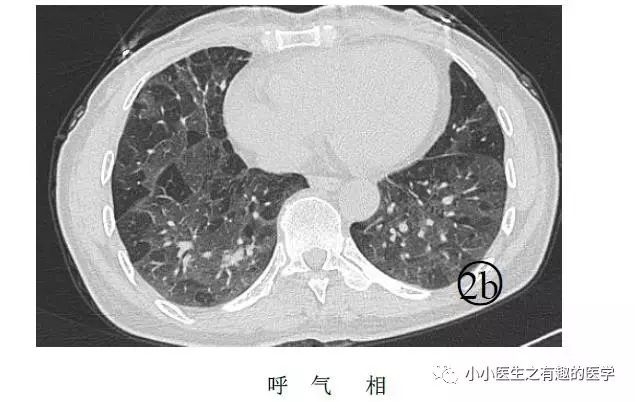 ct平扫肺部能查出是哮喘吗,ct平扫肺结节准确吗