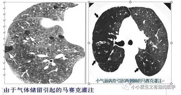 ct平扫肺部能查出是哮喘吗,ct平扫肺结节准确吗