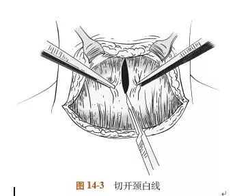 甲状腺全切喝酒,甲状腺全切食谱