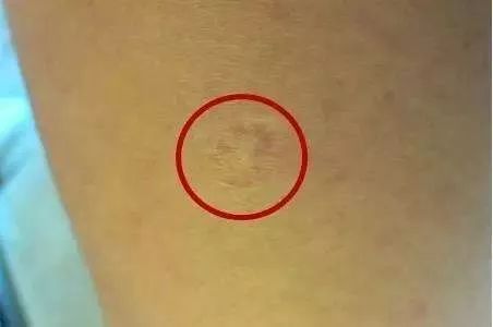 终于知道胳膊上的疤痕是怎么来的,终于知道为什么手臂上有疤了