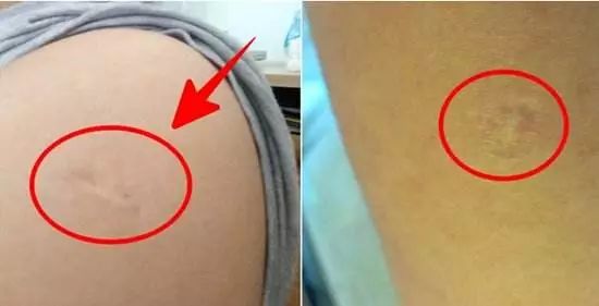 终于知道胳膊上的疤痕是怎么来的,终于知道为什么手臂上有疤了