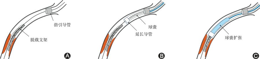 冠脉支架抗凝治疗专家共识,冠状动脉破裂的处理方法