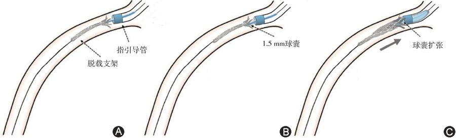 冠脉支架抗凝治疗专家共识,冠状动脉破裂的处理方法