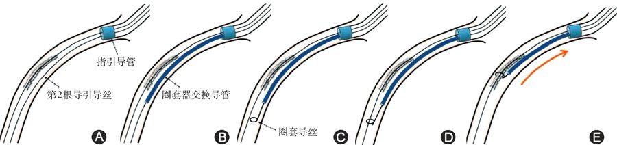 冠脉支架抗凝治疗专家共识,冠状动脉破裂的处理方法