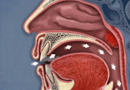 打呼噜也是一种病吗,睡觉打呼噜怎么治民间止鼾妙招
