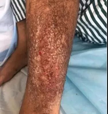 一男子用民间偏方治病险送命！这些偏方都是血淋淋的教训，千万别信