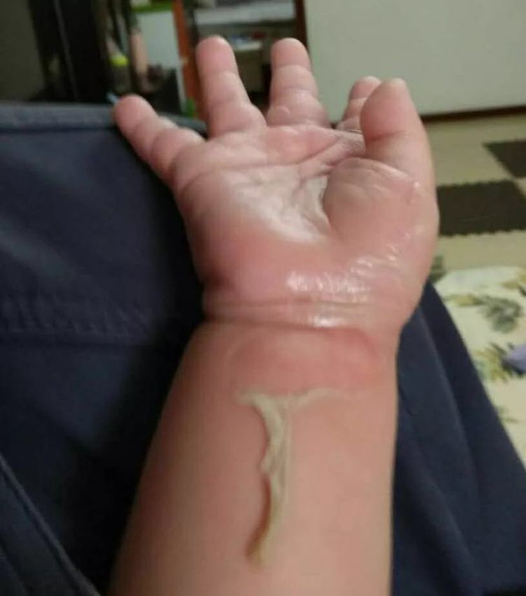 上海一岁半小孩烫伤,儿童烫伤家庭急救处理误区