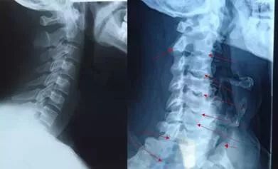 后脑勺骨刺是什么原因,后脑勺有骨刺怎么办