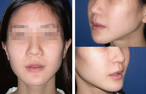 人中缩短还可以变回去吗,人中缩短值得做吗