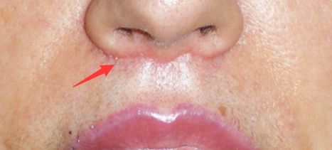 人中缩短还可以变回去吗,人中缩短值得做吗