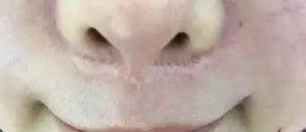 人中缩短还可以变回去吗,人中缩短值得做吗