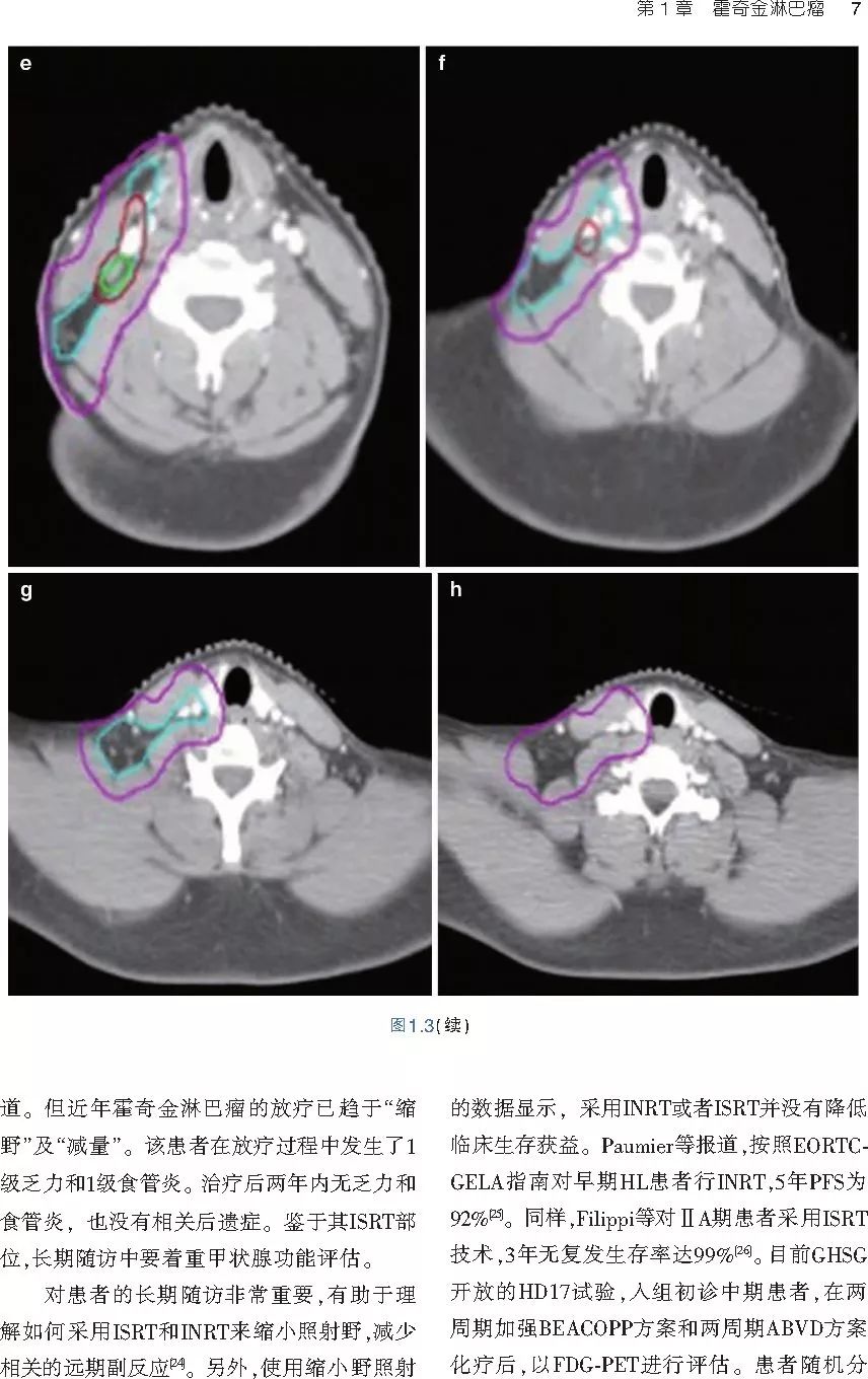 血液系统恶性肿瘤放射治疗：实用图解指南