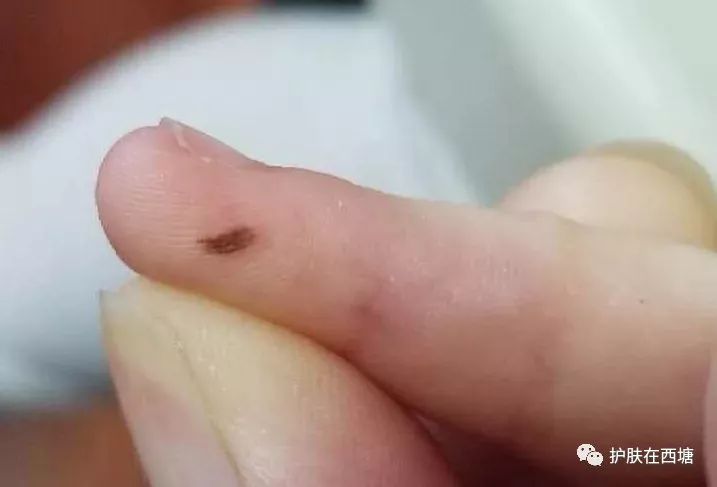 遮痣最简单的方法,褐青色痣的治疗方法