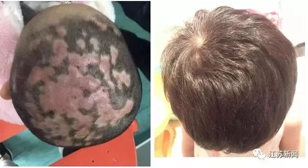 4岁女孩头发几乎掉光，头皮流脓！原因竟和家里这个有关