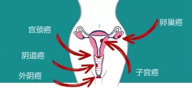 女人一生要过几个关,女性有哪些常见的肿瘤