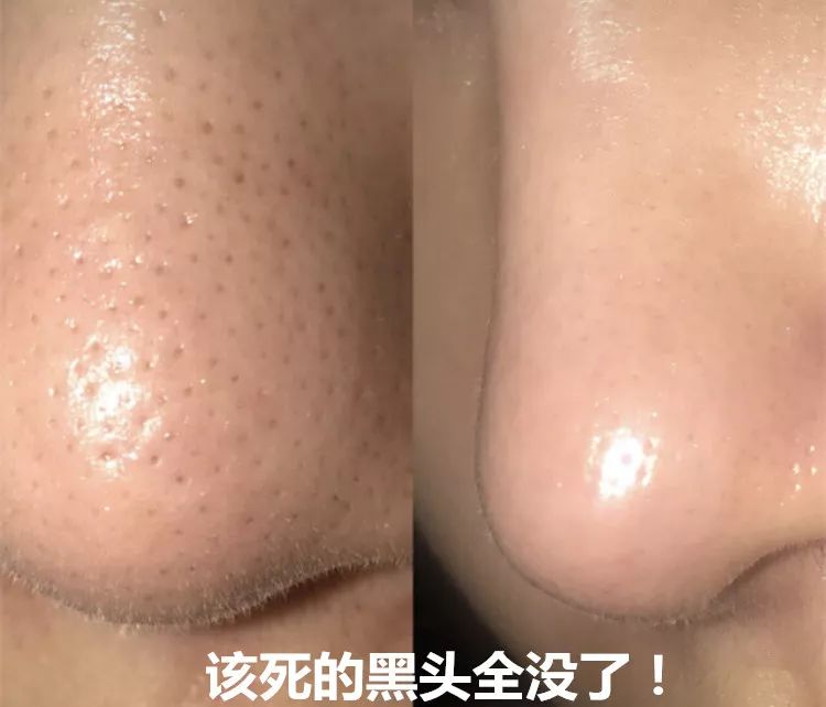 草莓鼻救星怎么治疗,草莓鼻去黑头神器视频