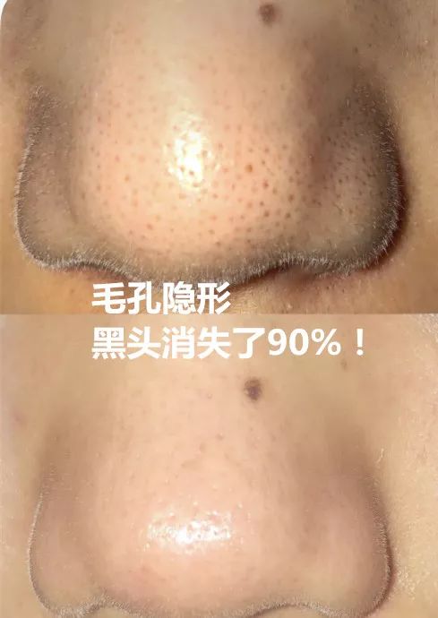 草莓鼻救星怎么治疗,草莓鼻去黑头神器视频