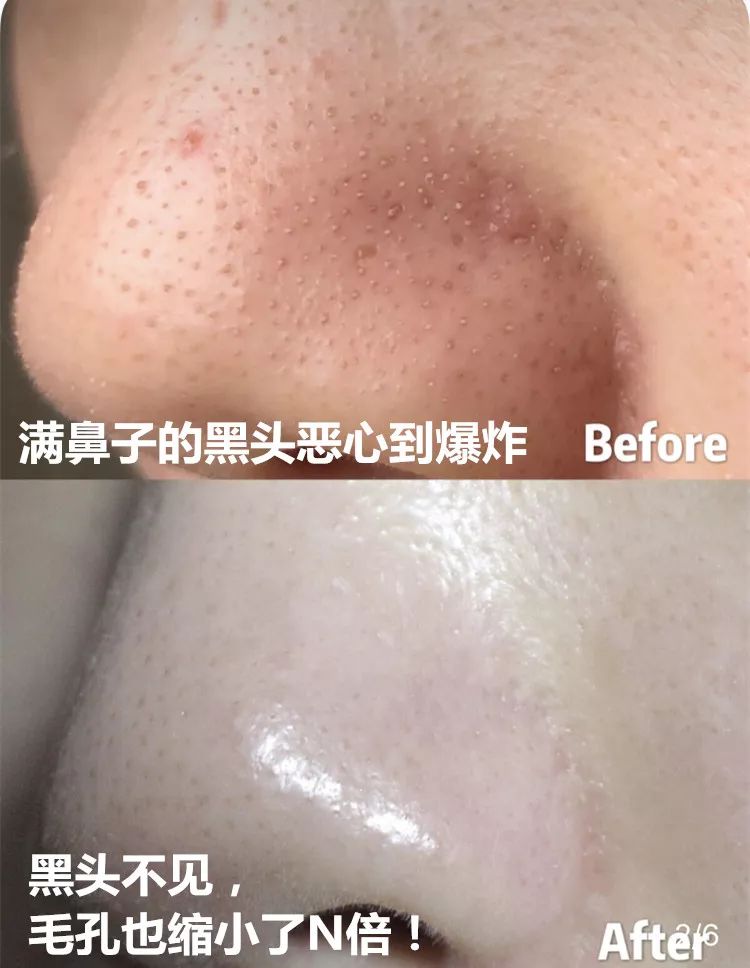 草莓鼻救星怎么治疗,草莓鼻去黑头神器视频