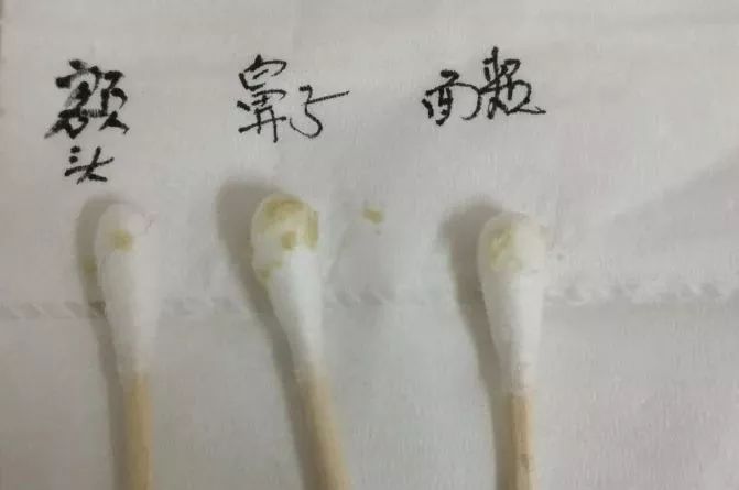 草莓鼻救星怎么治疗,草莓鼻去黑头神器视频