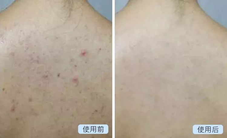 20分钟清理背部螨虫痘痘,十秒去除螨虫