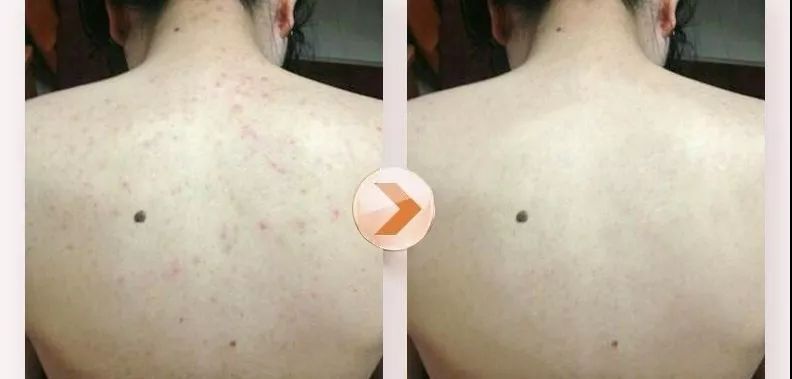 20分钟清理背部螨虫痘痘,十秒去除螨虫