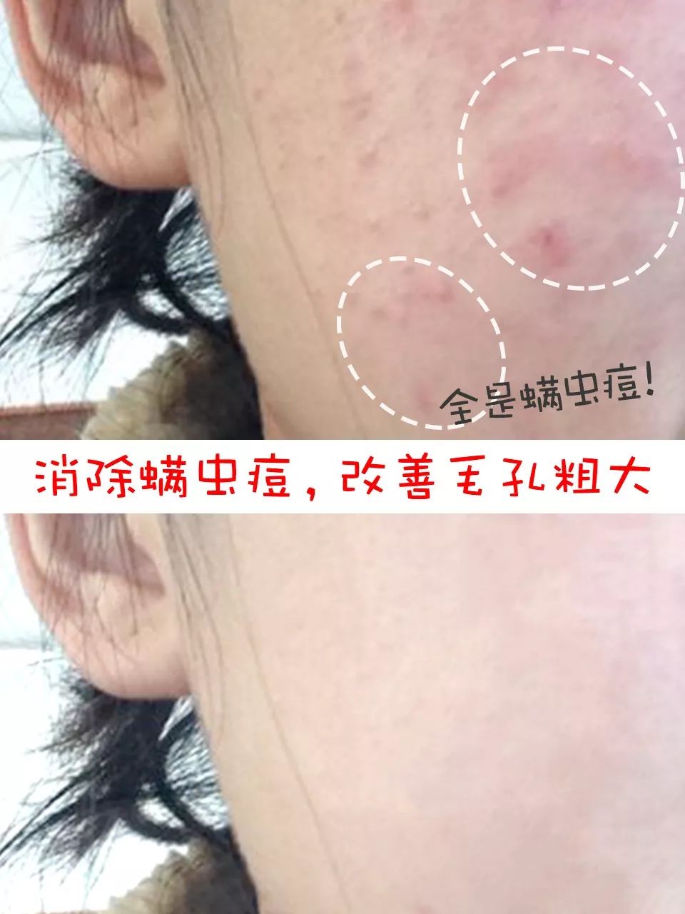 20分钟清理背部螨虫痘痘,十秒去除螨虫