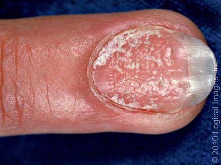 指甲很脆是因为缺少什么营养素,婴儿指甲特别脆是缺乏营养么