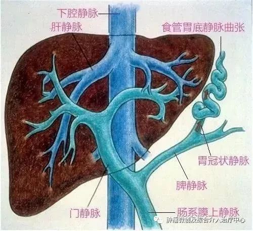 难治性消化道出血及难治性腹水的微创介入治疗-TIPS,运城市第一医院综合介入科