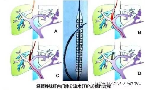 难治性消化道出血及难治性腹水的微创介入治疗-TIPS,运城市第一医院综合介入科