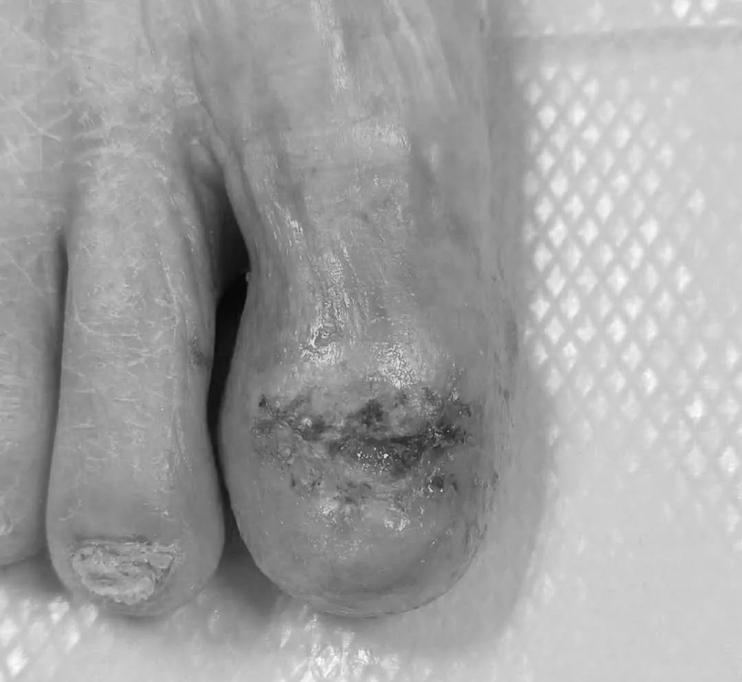 这画面太美！七旬阿婆脚拇趾疼痛流脓2年，原来竟是小东西惹的大祸