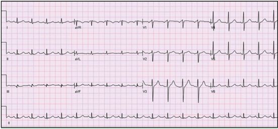 st段呈异常动态变化,st段动态改变提示什么