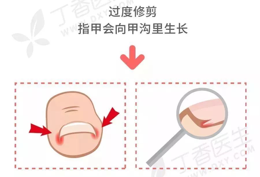 剪指甲错层,指甲该怎么剪才是正确的