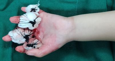 揪心2岁男孩掉进热水盆,揪心2岁男童被外婆摔成重伤