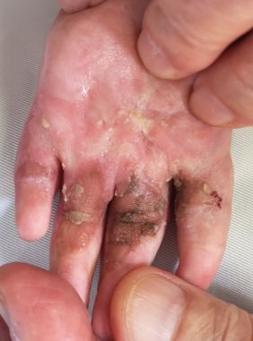 揪心2岁男孩掉进热水盆,揪心2岁男童被外婆摔成重伤