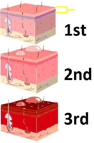 找真相|烫伤抹牙膏？鱼刺卡喉要喝醋？这些家庭急救误区你不可不知