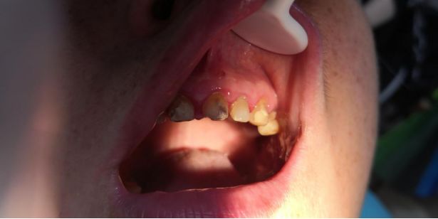 老掉牙怎么办吃什么可缓解,老掉牙什么意思