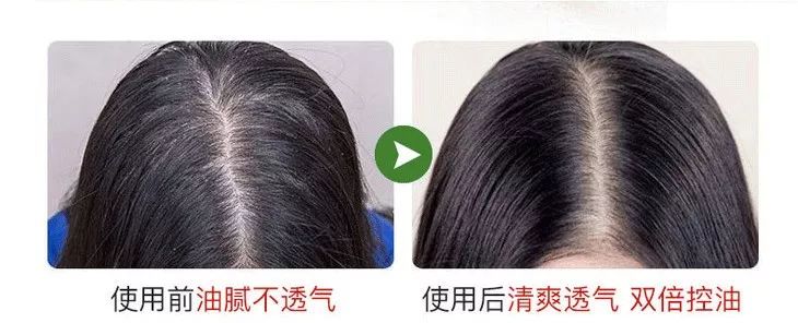 头皮发痒爱出油是什么引起的,头皮出油严重痒是什么原因引起的