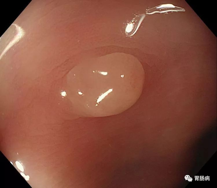 胃溃疡直肠息肉挂什么科,结肠直肠多发息肉看什么科