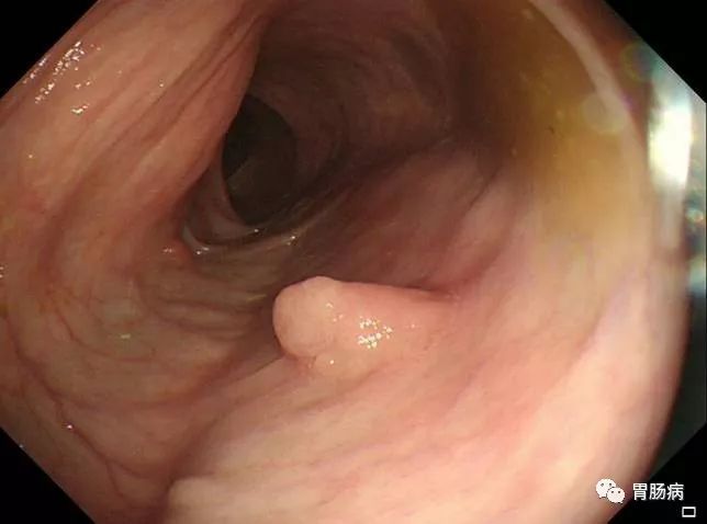 胃溃疡直肠息肉挂什么科,结肠直肠多发息肉看什么科