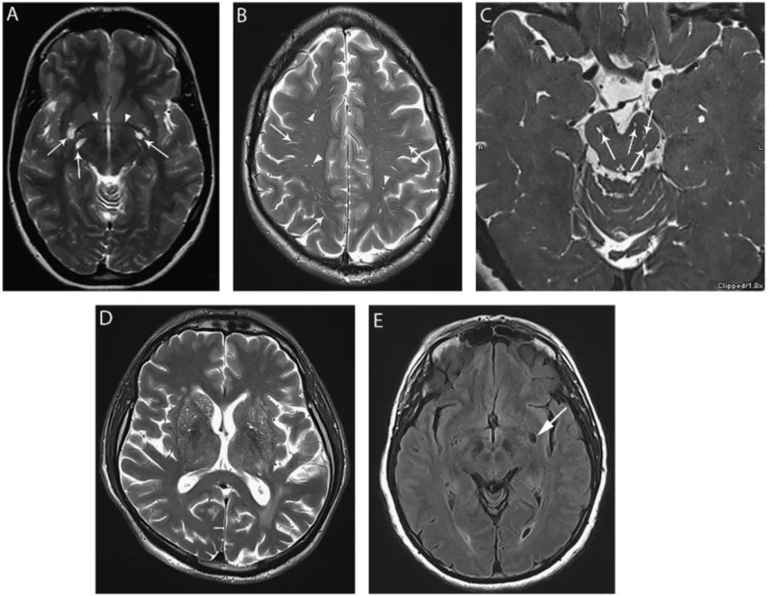 多图多表：带你识别颅内囊肿的影像学表现丨实战读片