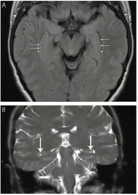 多图多表：带你识别颅内囊肿的影像学表现丨实战读片