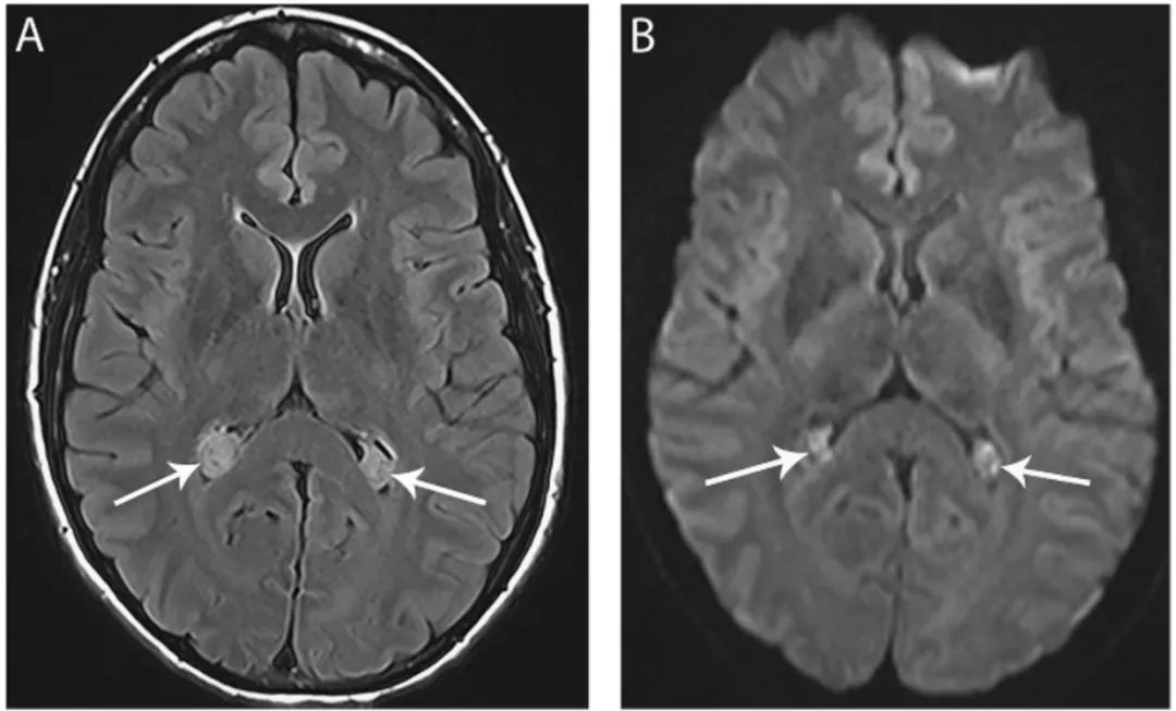 多图多表：带你识别颅内囊肿的影像学表现丨实战读片